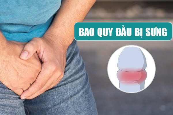 Bao quy đầu bị sưng: Nguyên nhân, dấu hiệu và cách chữa hiệu quả