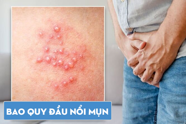Bao quy đầu nổi mụn là bị gì? Cách xử lý an toàn và hiệu quả nhanh