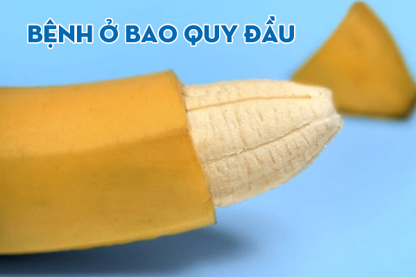 Các bệnh ở bao quy đầu nam giới không nên xem nhẹ