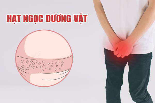 Cách điều trị chuỗi hạt ngọc dương vật hiện đại, hiệu quả nhanh