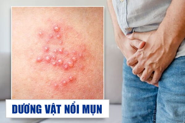 Dương vật nổi mụn – Dấu hiệu cảnh báo nhiều bệnh lý