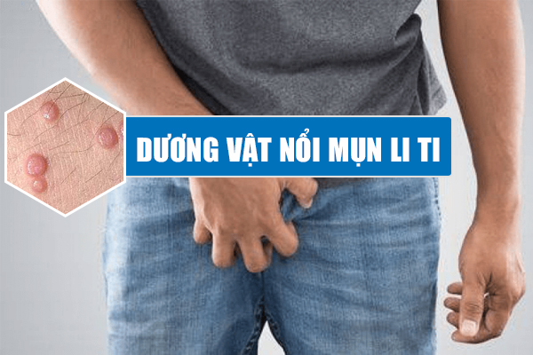 Dương vật nổi mụn li ti – Cẩn thận 5 bệnh nam khoa thường gặp
