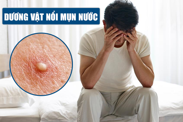 Dương vật nổi mụn nước – Nguyên nhân và địa chỉ khám chữa uy tín
