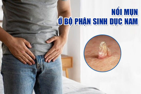 Nổi mụn ở bộ phận sinh dục nam – Dấu hiệu cảnh báo nhiều bệnh nam khoa
