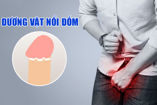 Dương vật nổi đốm là bị gì? Có sao không?