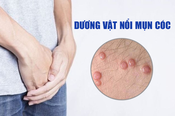 Dương vật nổi mụn cóc có tự khỏi không? Bác sĩ giải đáp chi tiết
